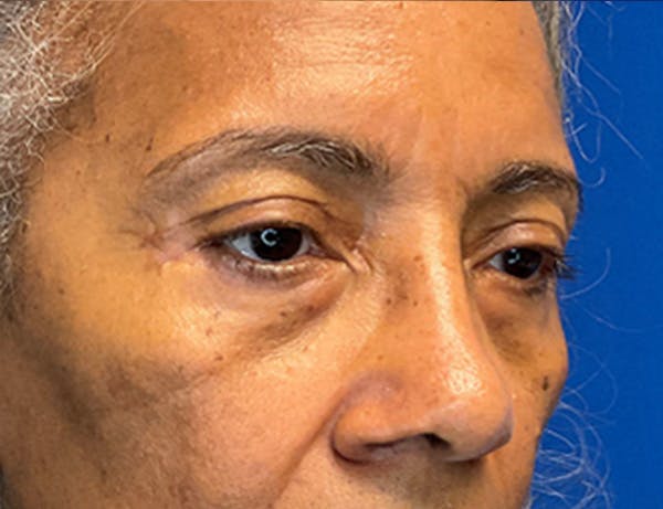 Blepharoplasty Before & After Gallery - Patient 237870 - Image 6