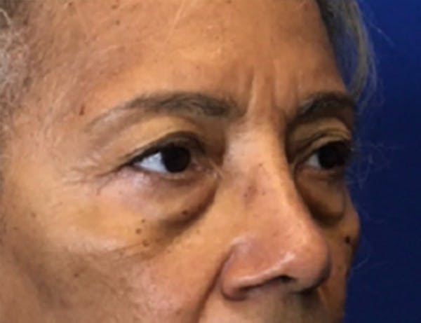 Blepharoplasty Before & After Gallery - Patient 237870 - Image 5