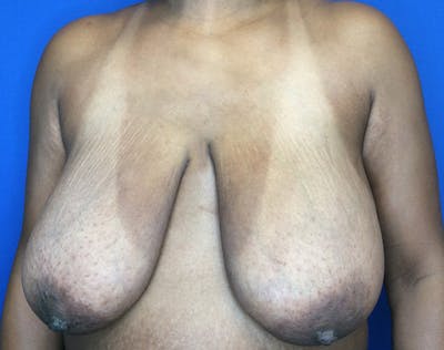 Breast Reduction Before & After Gallery - Patient 356605 - Image 1