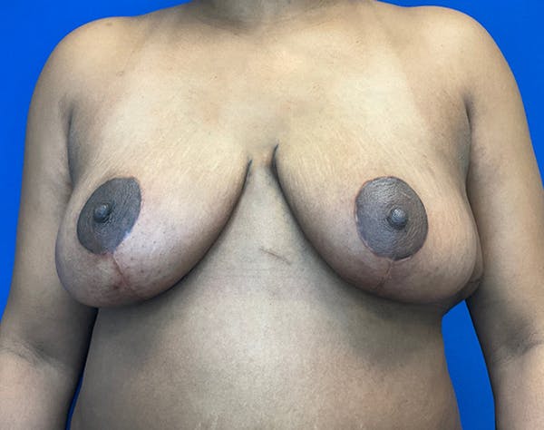 Breast Reduction Before & After Gallery - Patient 356605 - Image 2