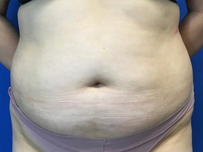 Liposuction Before & After Gallery - Patient 471365 - Image 1