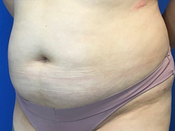Liposuction Before & After Gallery - Patient 471365 - Image 3