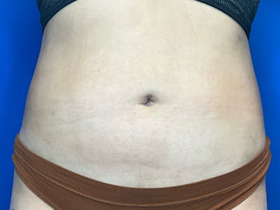 Liposuction Before & After Gallery - Patient 471365 - Image 2