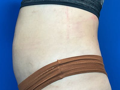 Liposuction Before & After Gallery - Patient 471365 - Image 6