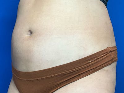 Liposuction Before & After Gallery - Patient 471365 - Image 4