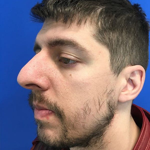 Rhinoplasty Before & After Gallery - Patient 279627 - Image 3