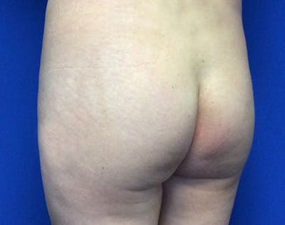 Brazilian Butt Lift Before & After Gallery - Patient 261106 - Image 1