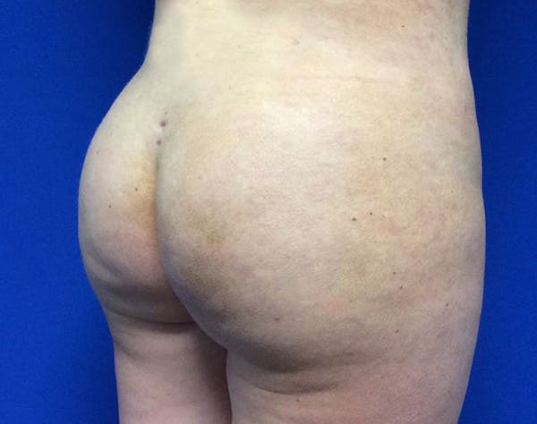 Brazilian Butt Lift Before & After Gallery - Patient 261106 - Image 4