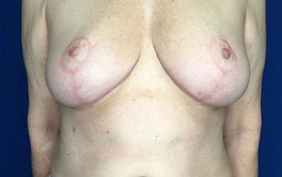 Breast Reduction Before & After Gallery - Patient 201694 - Image 2