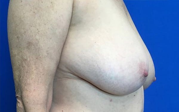 Breast Reduction Before & After Gallery - Patient 201694 - Image 3
