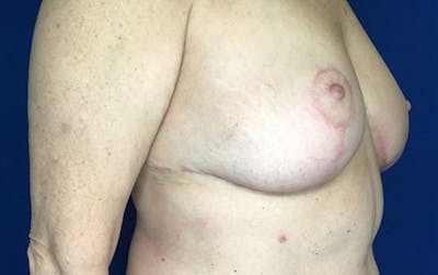 Breast Reduction Before & After Gallery - Patient 201694 - Image 4