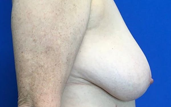 Breast Reduction Before & After Gallery - Patient 201694 - Image 5