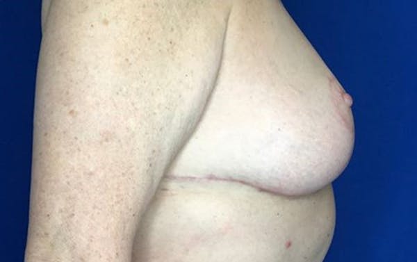 Breast Reduction Before & After Gallery - Patient 201694 - Image 6