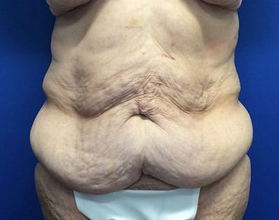 Post Bariatric Before & After Gallery - Patient 596138 - Image 1
