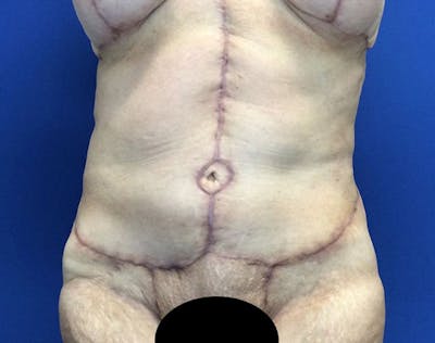 Tummy Tuck (Abdominoplasty) Before & After Gallery - Patient 232613 - Image 2