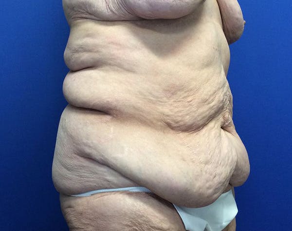 Post Bariatric Before & After Gallery - Patient 596138 - Image 3