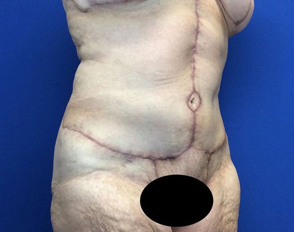 Post Bariatric Before & After Gallery - Patient 596138 - Image 4