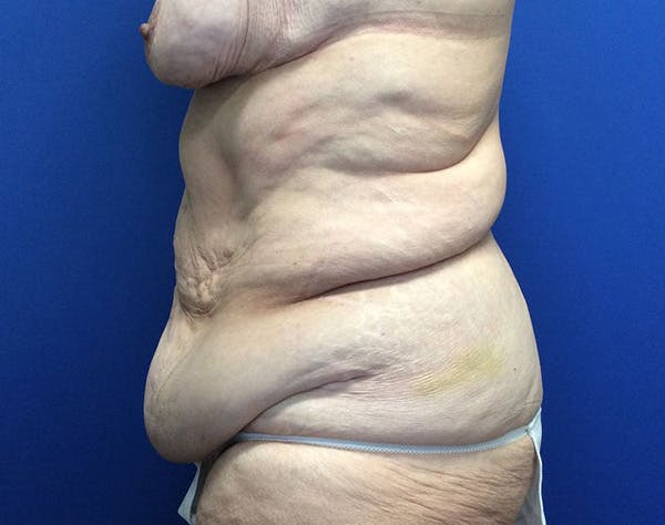 Tummy Tuck (Abdominoplasty) Before & After Gallery - Patient 232613 - Image 5