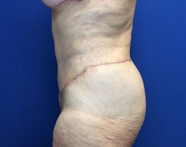 Post Bariatric Before & After Gallery - Patient 596138 - Image 6