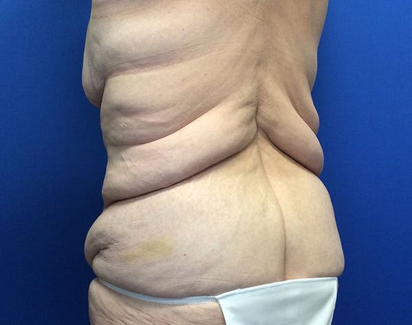 Post Bariatric Before & After Gallery - Patient 596138 - Image 7