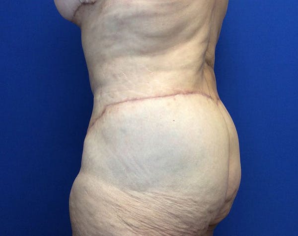 Post Bariatric Before & After Gallery - Patient 596138 - Image 8