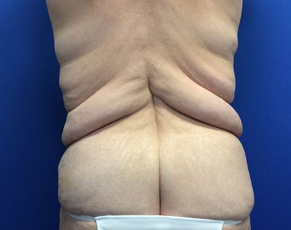 Post Bariatric Before & After Gallery - Patient 596138 - Image 9
