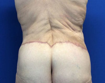 Post Bariatric Before & After Gallery - Patient 596138 - Image 10
