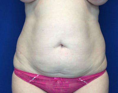 Liposuction Before & After Gallery - Patient 320111 - Image 1
