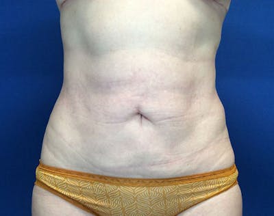 Liposuction Before & After Gallery - Patient 320111 - Image 2