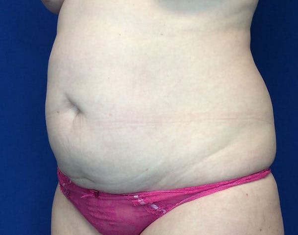 Liposuction Before & After Gallery - Patient 320111 - Image 3