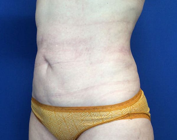 Liposuction Before & After Gallery - Patient 320111 - Image 4