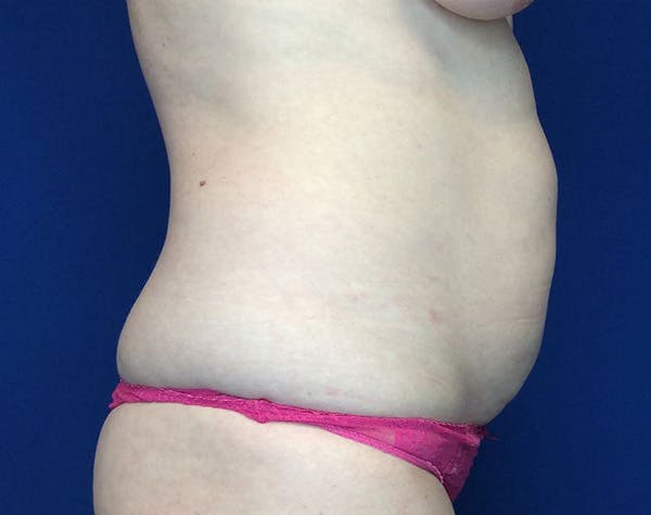 Liposuction Before & After Gallery - Patient 320111 - Image 5