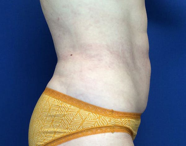 Liposuction Before & After Gallery - Patient 320111 - Image 6