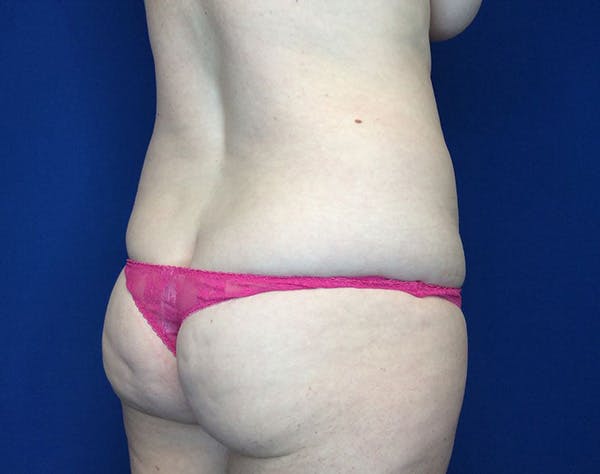 Liposuction Before & After Gallery - Patient 320111 - Image 7