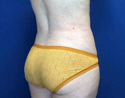 Liposuction Before & After Gallery - Patient 320111 - Image 8