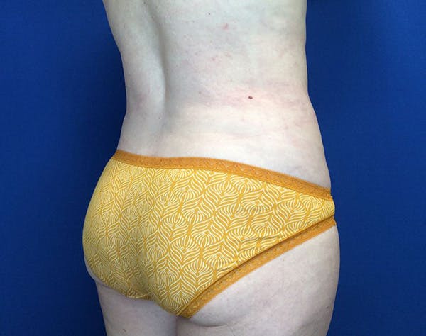 Liposuction Before & After Gallery - Patient 320111 - Image 8