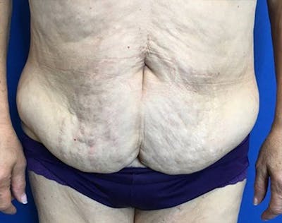 Tummy Tuck (Abdominoplasty) Before & After Gallery - Patient 502226 - Image 1