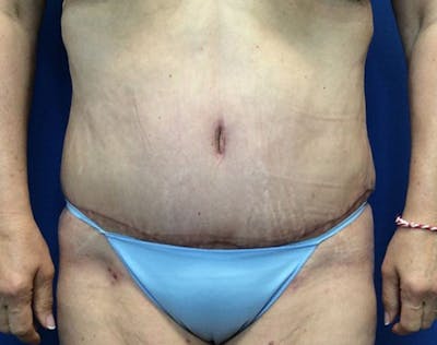 Tummy Tuck (Abdominoplasty) Before & After Gallery - Patient 502226 - Image 2