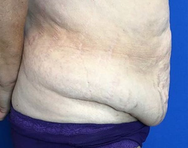Tummy Tuck (Abdominoplasty) Before & After Gallery - Patient 502226 - Image 3