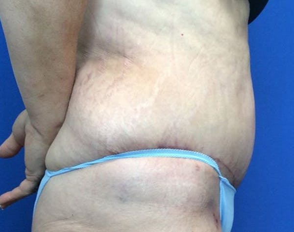 Liposuction Before & After Gallery - Patient 232766 - Image 4