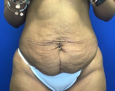 Tummy Tuck (Abdominoplasty) Before & After Gallery - Patient 366656 - Image 1