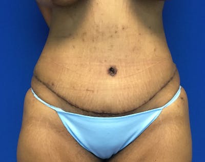 Tummy Tuck (Abdominoplasty) Before & After Gallery - Patient 366656 - Image 2