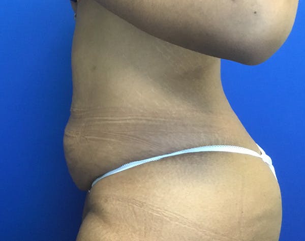 Tummy Tuck (Abdominoplasty) Before & After Gallery - Patient 366656 - Image 3