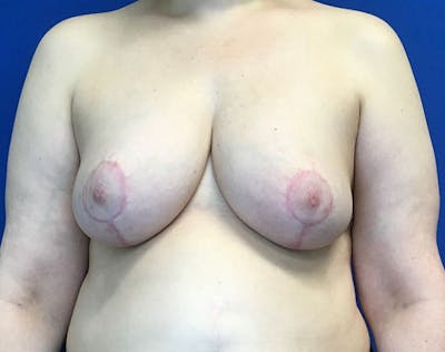 Breast Reduction Before & After Gallery - Patient 163340 - Image 2