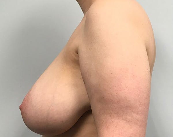 Breast Reduction Before & After Gallery - Patient 163340 - Image 3