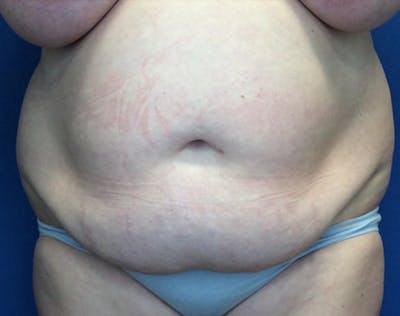 Liposuction Before & After Gallery - Patient 191224 - Image 1