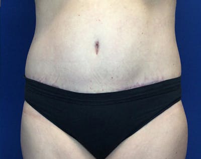 Liposuction Before & After Gallery - Patient 191224 - Image 2