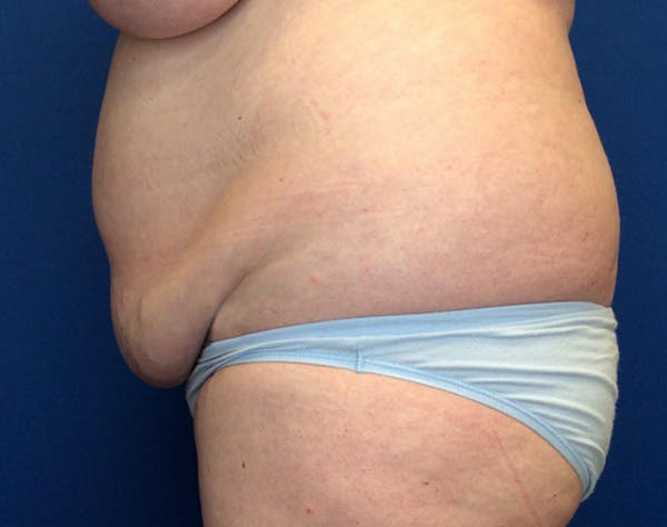 Liposuction Before & After Gallery - Patient 191224 - Image 3