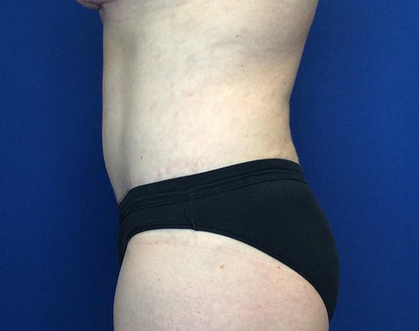Liposuction Before & After Gallery - Patient 191224 - Image 4