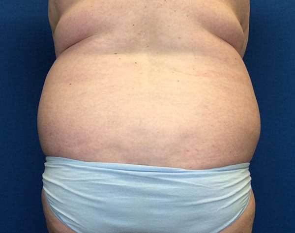 Liposuction Before & After Gallery - Patient 191224 - Image 5
